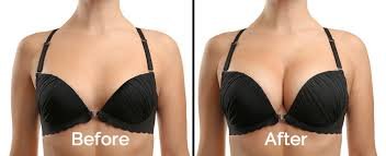 BREAST AUGMENTATION